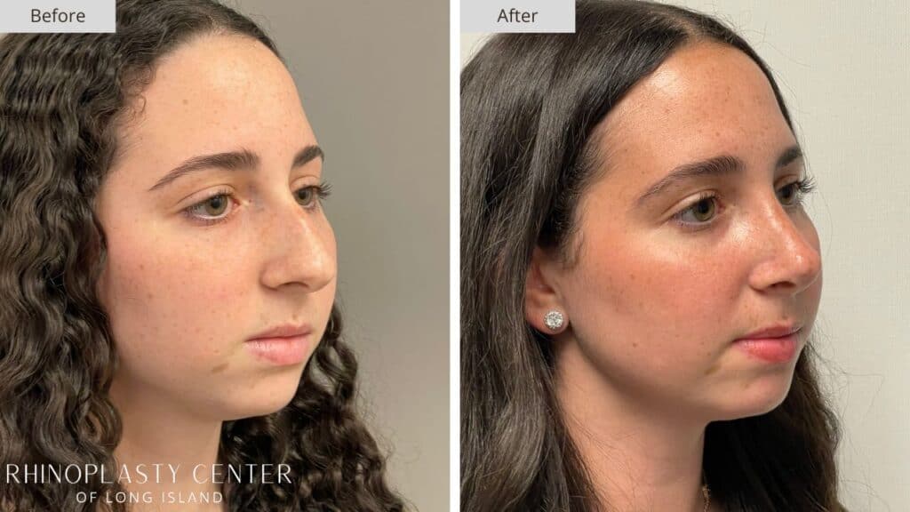 Rhinoplasty Center of Long Island Before and After Patient 206b