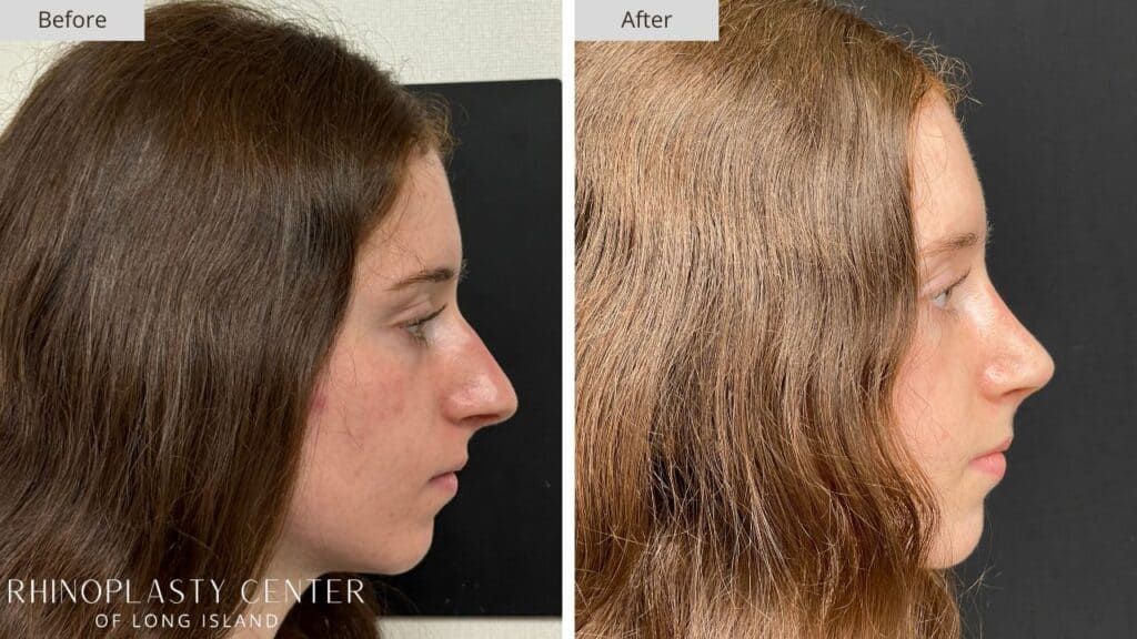 Rhinoplasty Center of Long Island Before and After Patient 207a