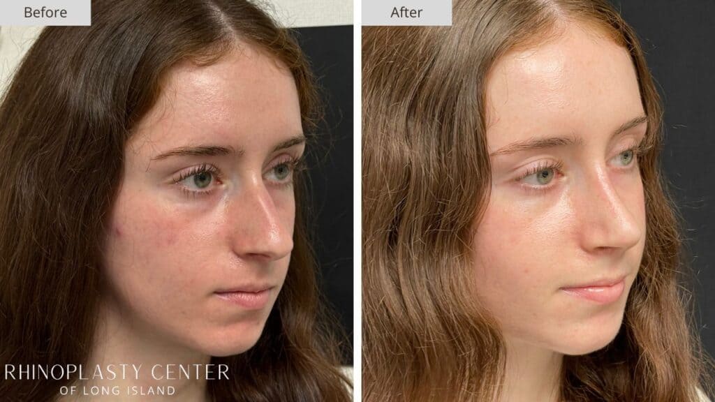 Rhinoplasty Center of Long Island Before and After Patient 207b
