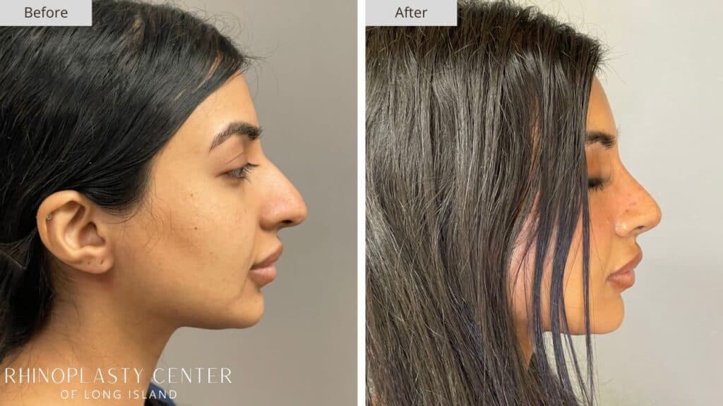 Rhinoplasty Center of Long Island Before and After Patient 208a