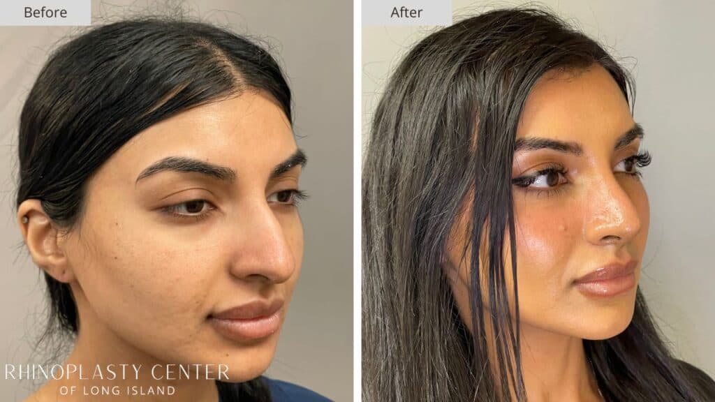 Rhinoplasty Center of Long Island Before and After Patient 208b