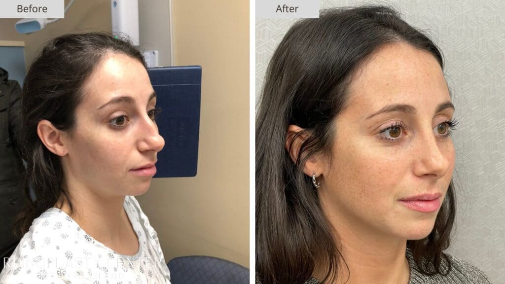 Rhinoplasty Center of Long Island Before and After Patient 209b